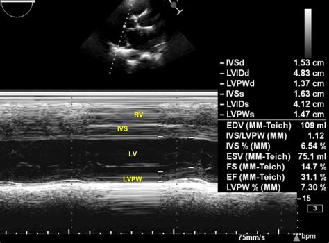 m mode echocardiogram left ventricular dysfunction